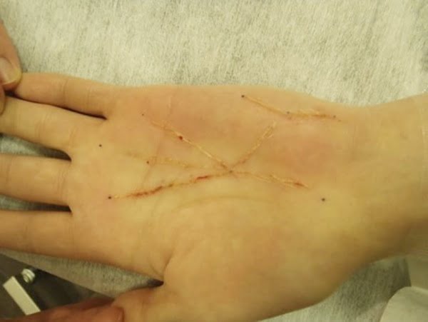 japon cirugias manos (2)