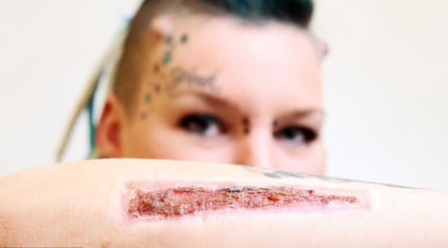 remover tatuaje