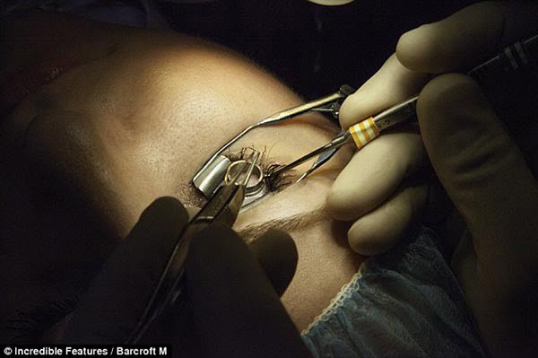 Implantes de platino en los ojos, la nueva moda estética corazon de platino en el ojo 2